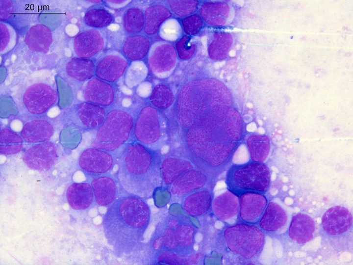 Lymph node touch imprint: large atypical cell resembling a Sternberg cell