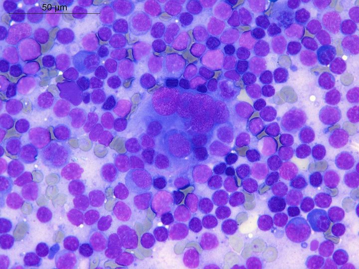 Lymph node touch imprint: aggregate of tumor FDCS against a background of mature lymphocytes (50 µm)