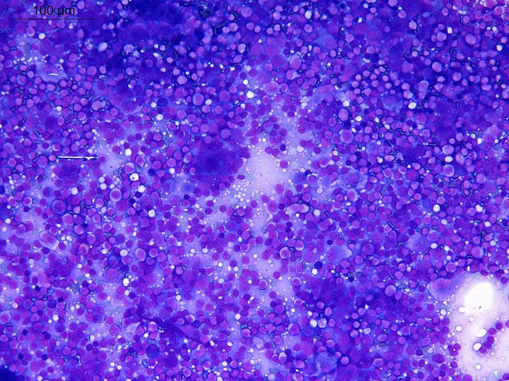 Lymph node touch imprint: hypercellular preparation at low magnification (scale 100 µm)