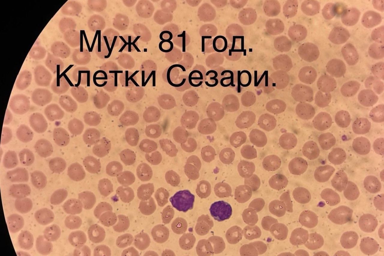 Синдром Сезари. Первичная Т-клеточная кожная лимфома