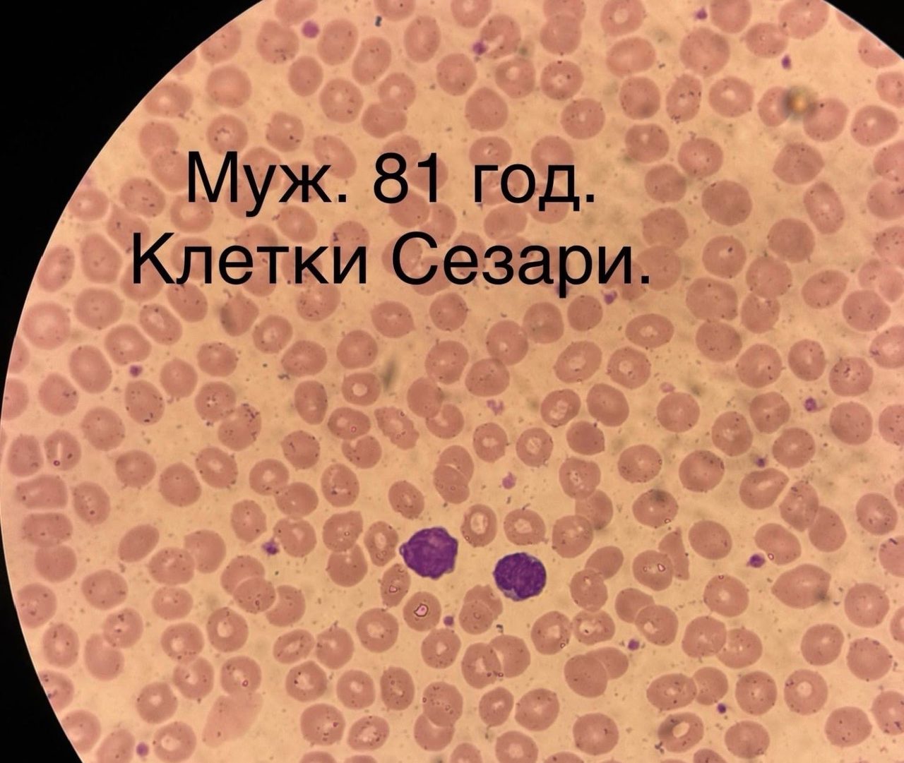 Синдром Сезари. Первичная Т-клеточная кожная лимфома