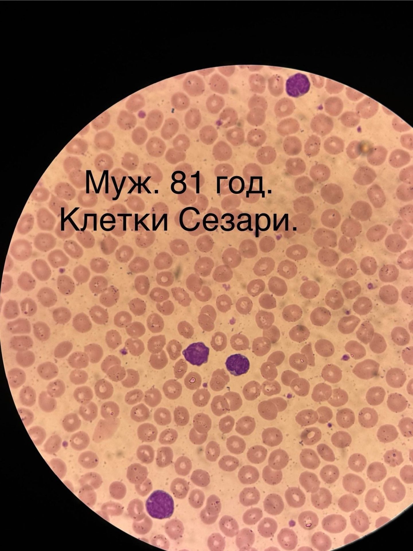Клетки Сезари в периферической крови