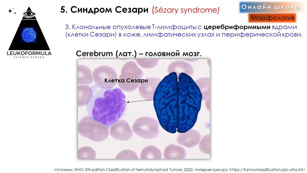 Клетки Сезари в периферической крови