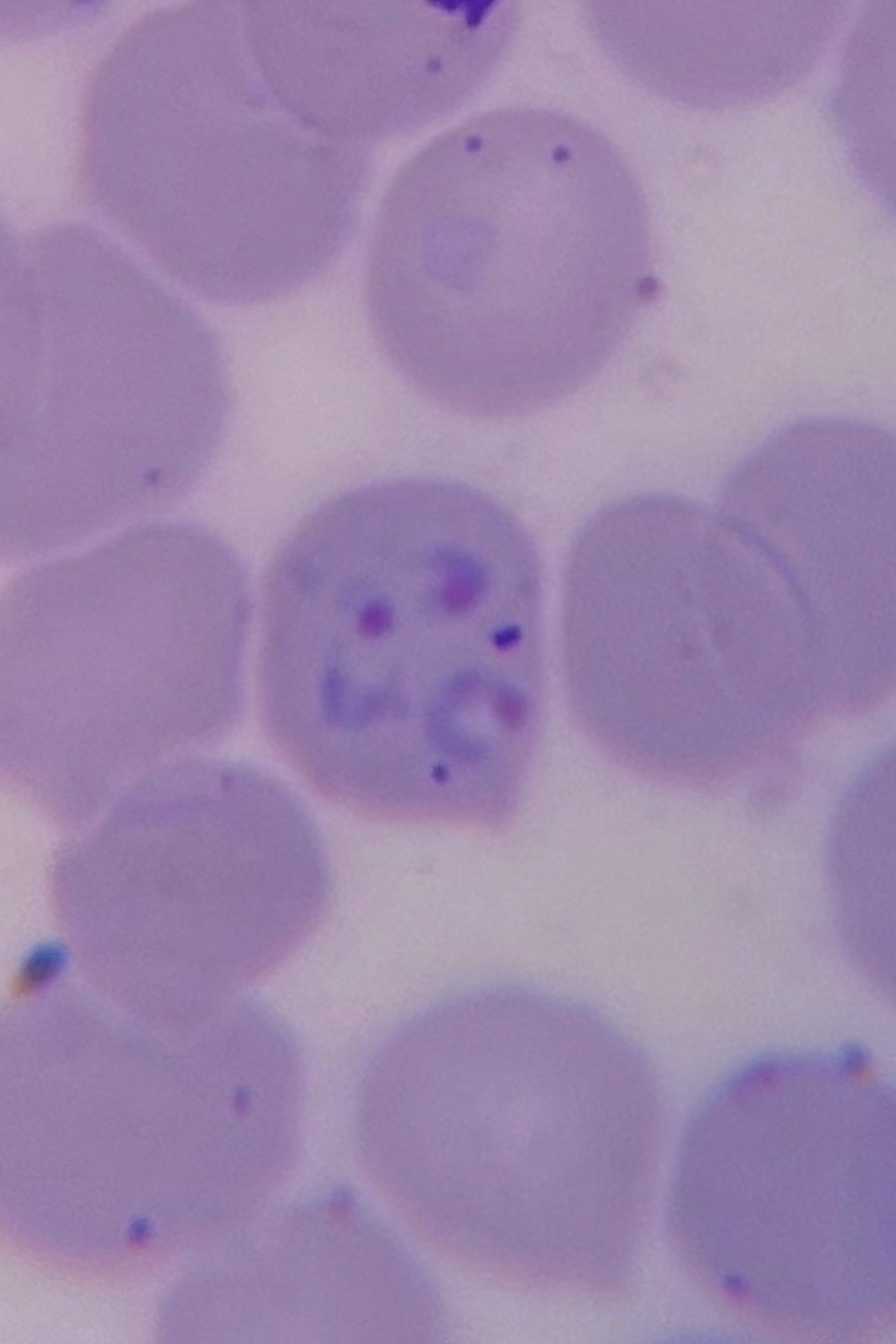 Шизонты Plasmodium vivax в тонком мазке крови
