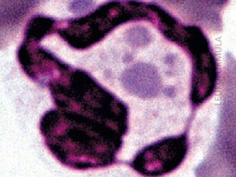 Мазок крови: нейтрофил с аномальными крупными гранулами в цитоплазме