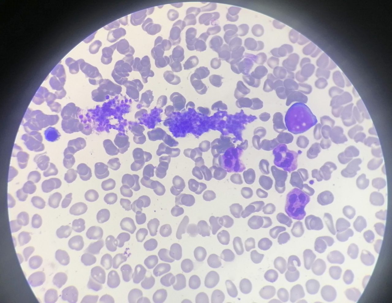 Platelet Aggregates in Bone Marrow Aspirate
