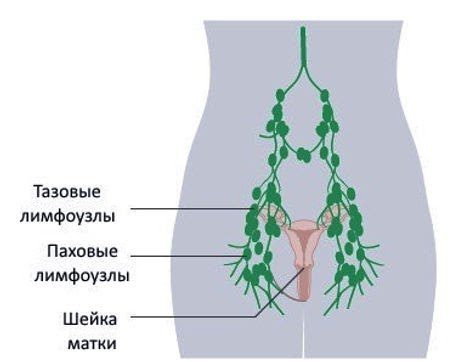 Симптомы лимфомы у женщин: увеличены лимфоузлы, что делать