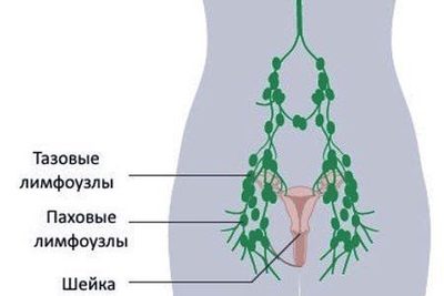 Симптомы лимфомы у женщин: увеличены лимфоузлы, что делать