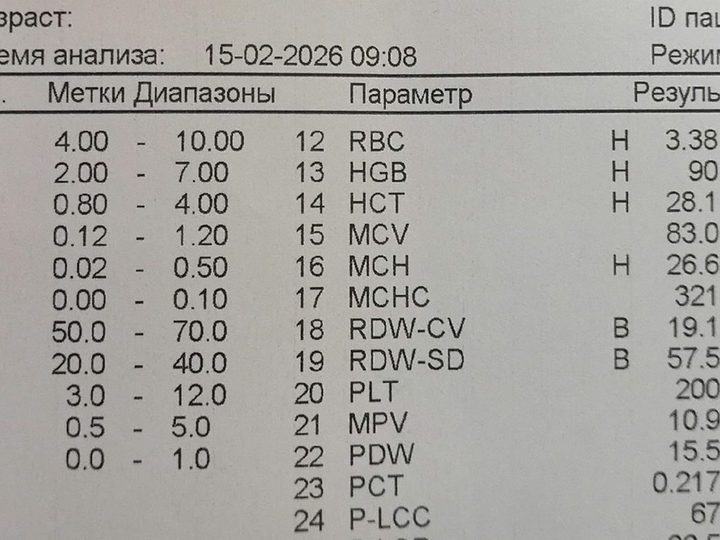 Распечатка анализатора: анемия с HGB 90 г/л и анизоцитоз RDW 19,1%