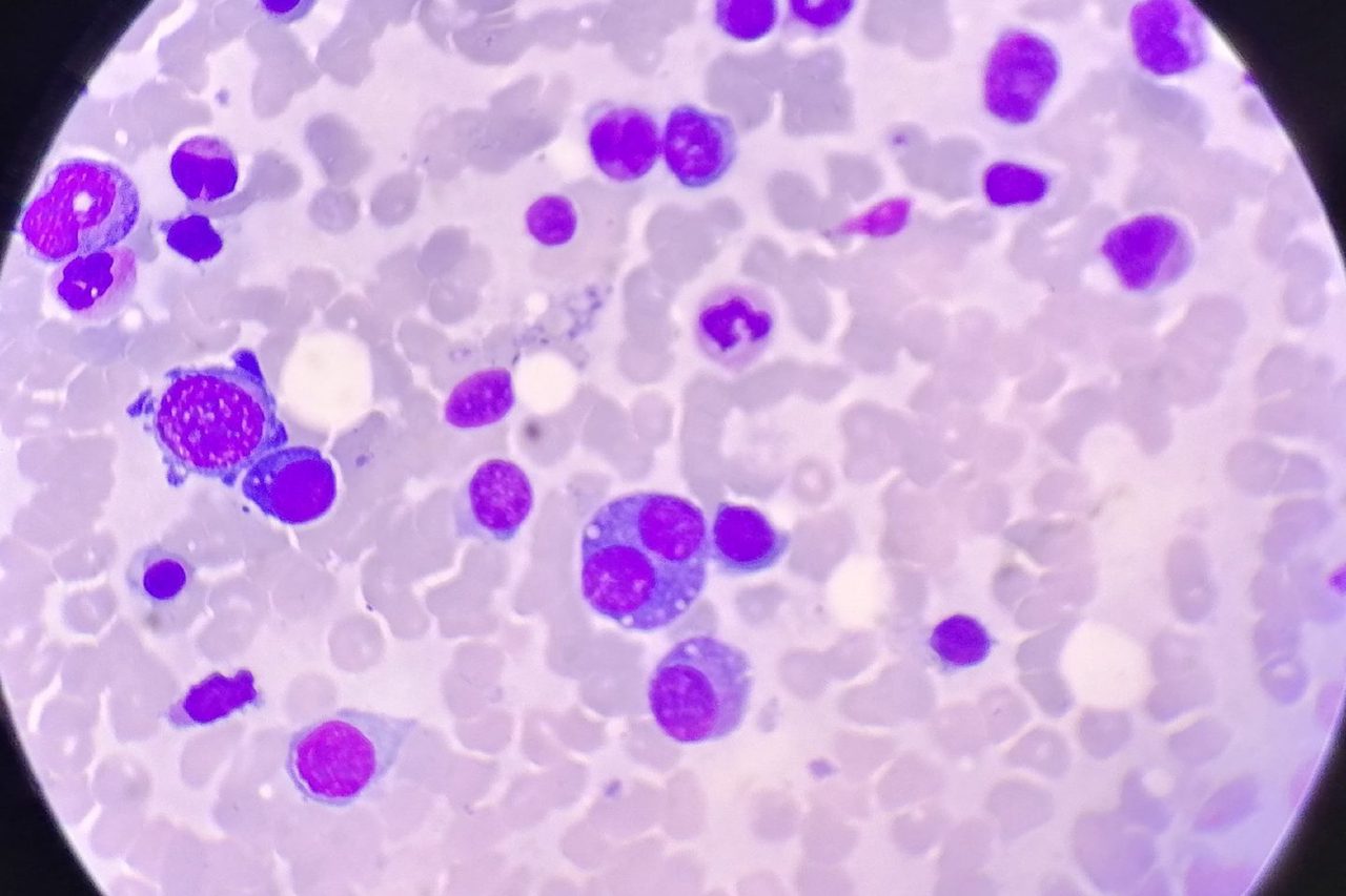 Russell Bodies and Binucleated Plasma Cells in Bone Marrow