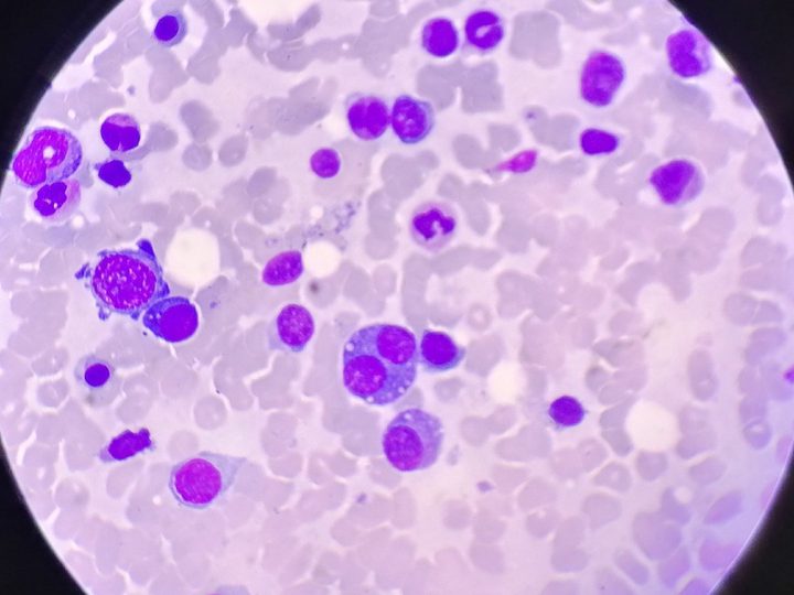 Bone marrow smear: binucleated plasma cell and cell with Russell bodies