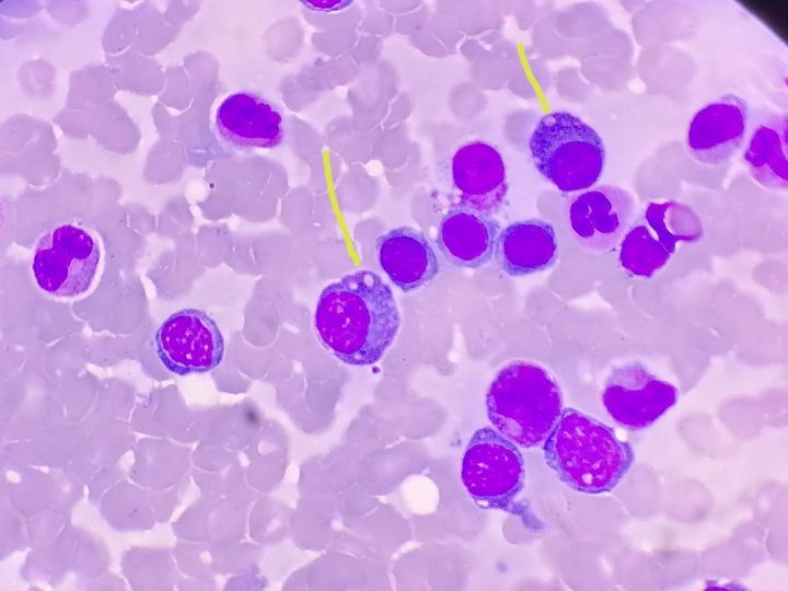 Bone marrow smear: arrows indicate plasma cells with Russell bodies