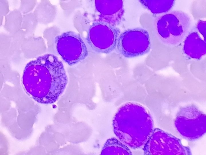 Bone marrow smear, higher magnification: plasma cell with Russell bodies