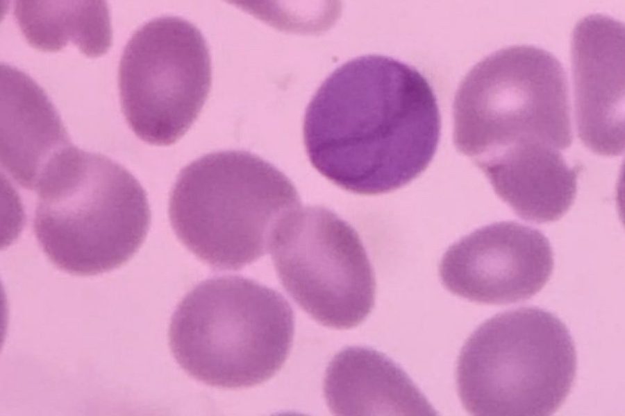 Cabot Rings and Howell-Jolly Bodies in Peripheral Blood Smear
