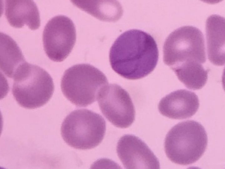 Blood smear: basophilic erythrocyte with a characteristic Cabot ring