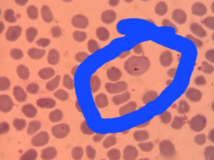 Blood smear: erythrocyte with a small Howell-Jolly body inside a blue contour