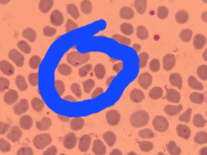 Blood smear: basophilic Howell-Jolly body in an erythrocyte, highlighted by a marker