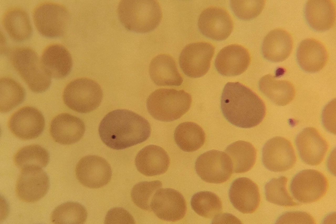 Howell-Jolly Bodies in Erythrocytes: Causes and Morphology