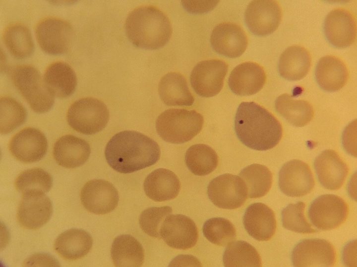 Blood smear: single Howell-Jolly bodies in two erythrocytes