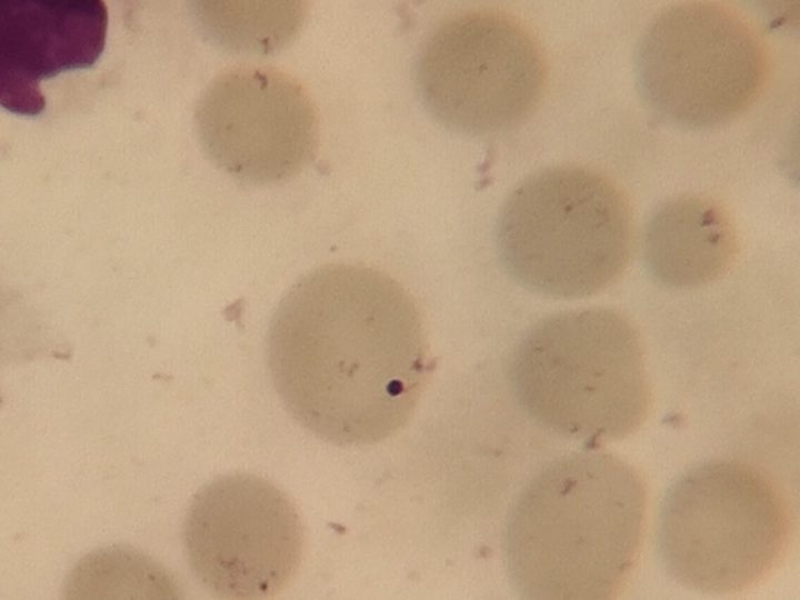 Blood smear: rounded nuclear Howell-Jolly inclusion in erythrocyte cytoplasm