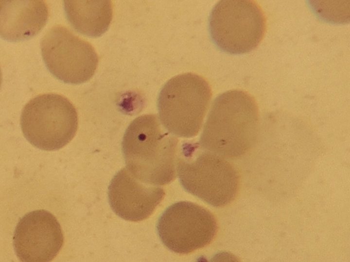 Blood smear: Howell-Jolly body in an erythrocyte amidst platelets