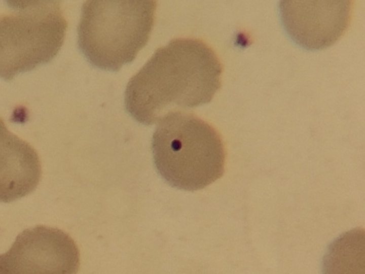 Blood smear: isolated Howell-Jolly body within a mature erythrocyte