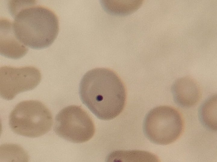 Blood smear: Howell-Jolly body in an erythrocyte under light microscopy