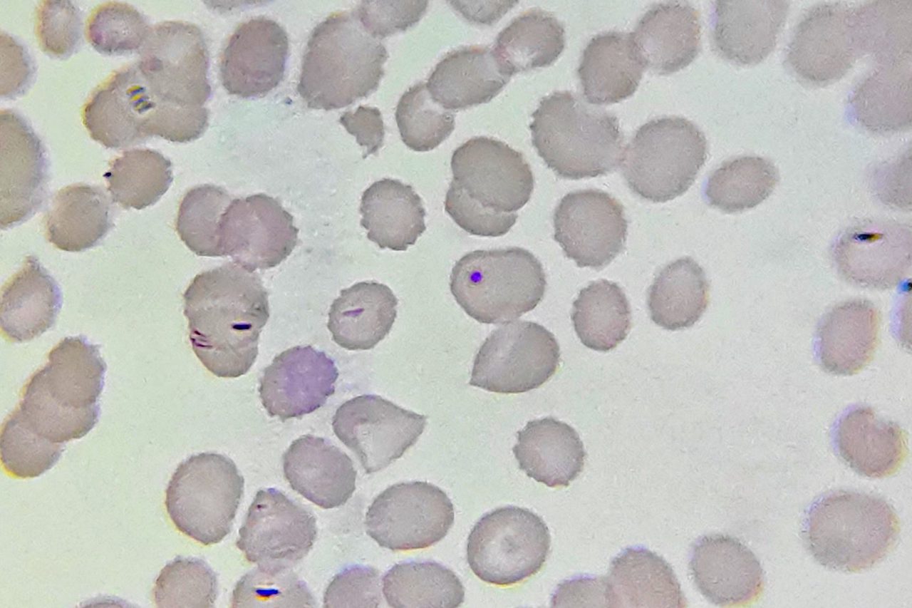 Howell-Jolly Bodies in Blood Smear: Morphology and Causes