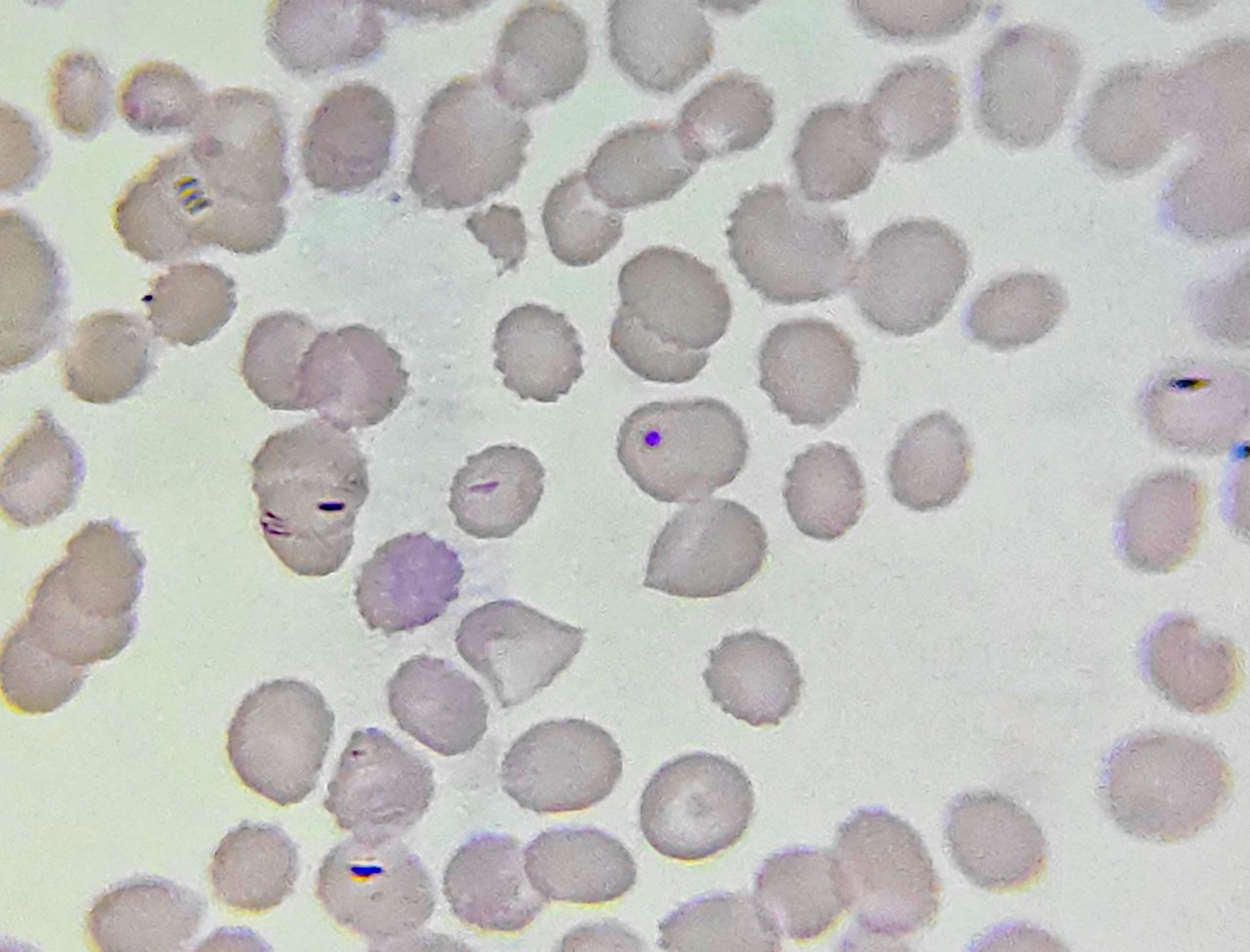 Blood smear: basophilic round inclusion (Howell-Jolly body) in an erythrocyte