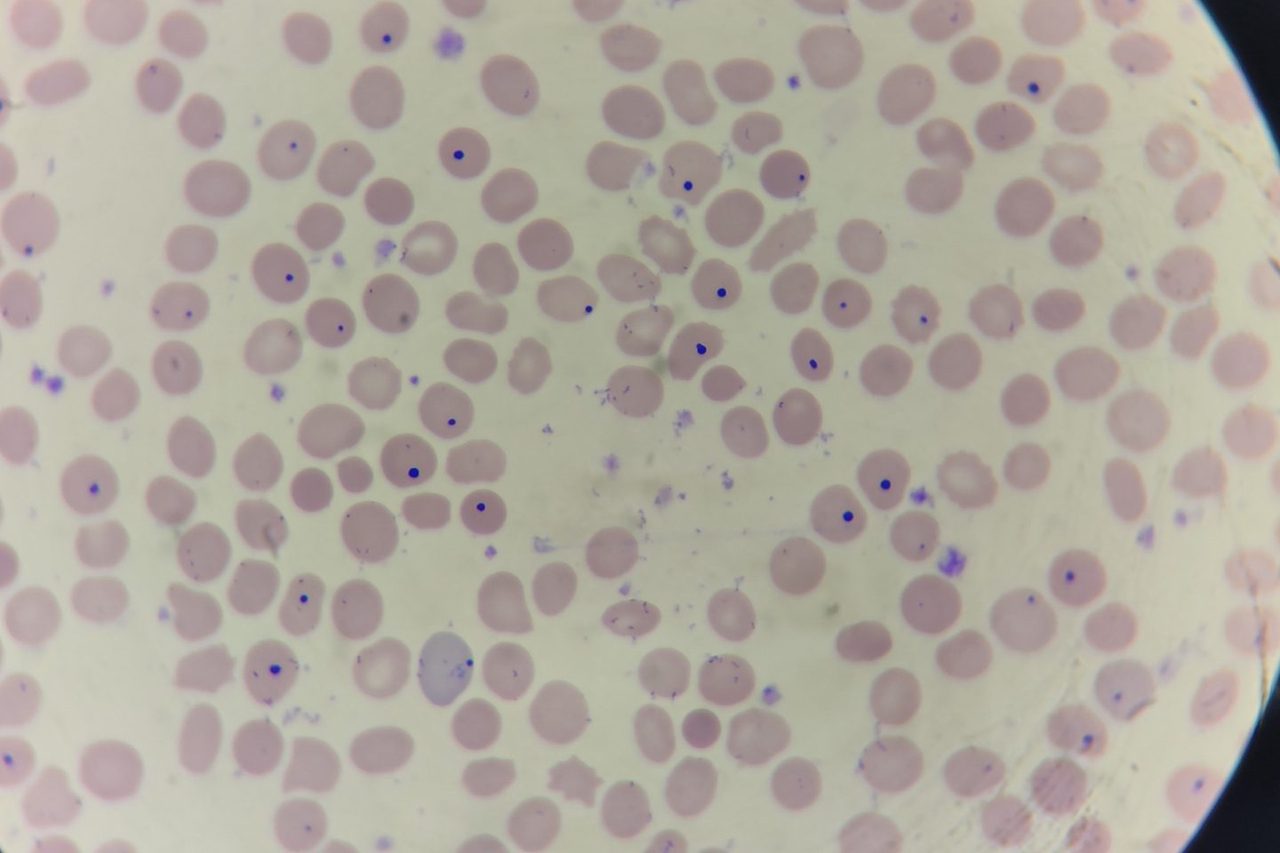 Howell-Jolly Bodies in Blood Smear: Causes and Morphology
