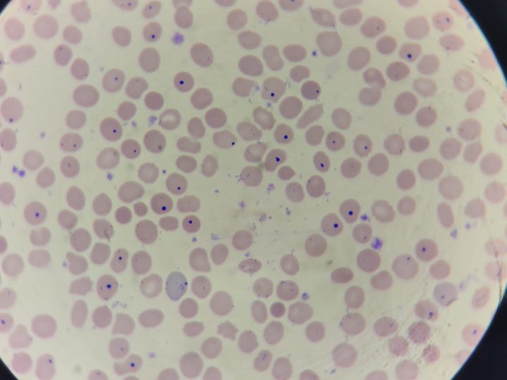 Blood smear: multiple round inclusions — Howell-Jolly bodies in erythrocytes