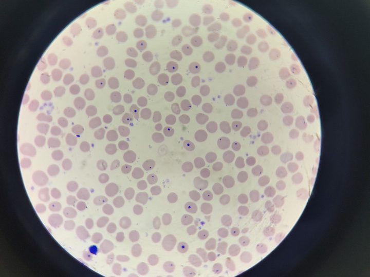 Blood smear: high number of erythrocytes with Howell-Jolly bodies