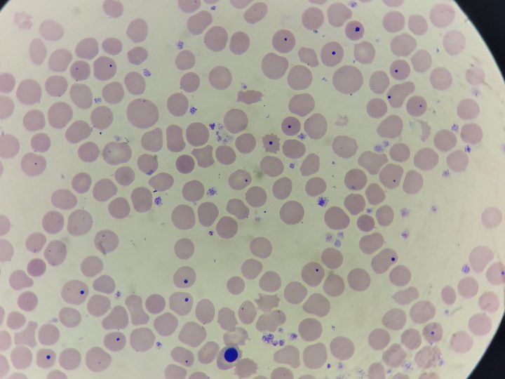 Blood smear: erythrocytes with Howell-Jolly bodies and a normoblast at the bottom of the field