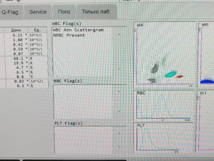 Analyzer screen: macrocytosis MCV 110.6 fL, thrombocytosis and NRBC Present flag