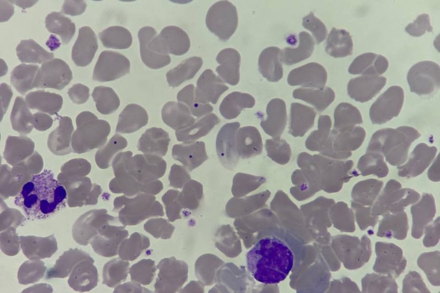 Howell-Jolly Bodies in Neonatal Peripheral Blood Smear