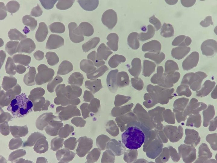 Blood smear: erythrocytes with Howell-Jolly bodies, neutrophil, and mononucleated cell