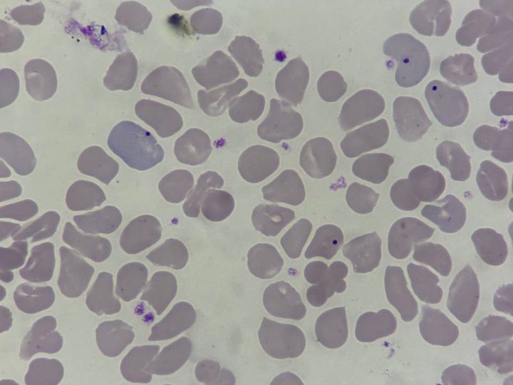 Blood smear: punctate Howell-Jolly bodies within neonatal erythrocytes