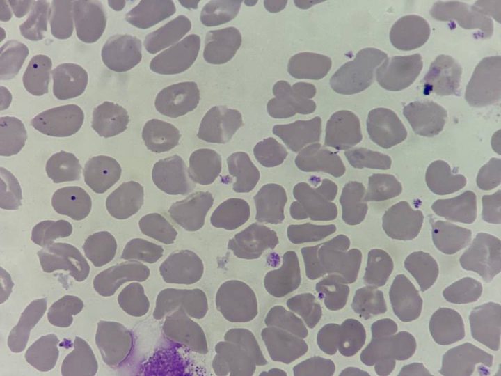Blood smear: erythrocytes with Howell-Jolly inclusions and a disintegrated leukocyte