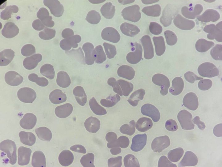 Blood smear: multiple Howell-Jolly bodies in erythrocytes at x100 magnification