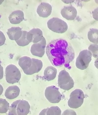 Barr Body in Neutrophil: Morphology of Sex Chromatin