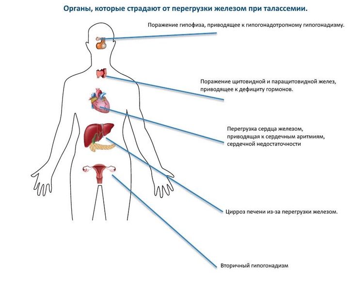 Диагноз — талассемия. Как подготовиться к беременности?