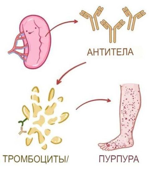 Почему возникает геморрагическая сыпь при иммунной тромбоцитопении