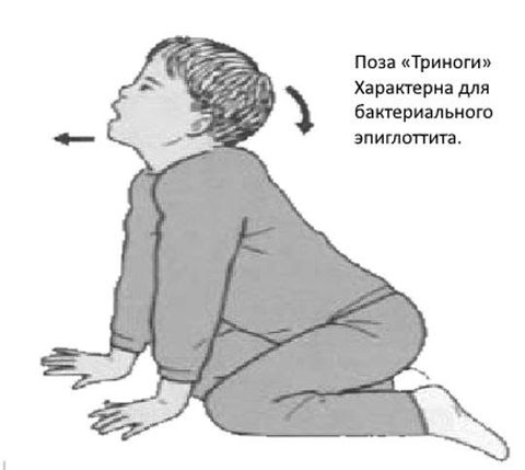 Pseudomonas aeruginosa — бактериальная инфекция с устойчивостью ко всем видам антибиотиков