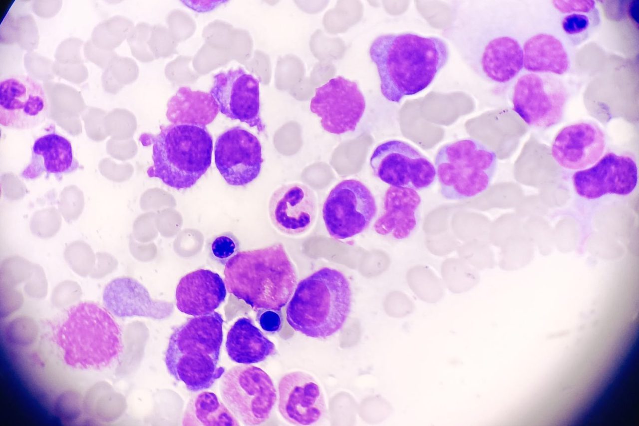 Myeloma Transformation to Plasmablastic Leukemia