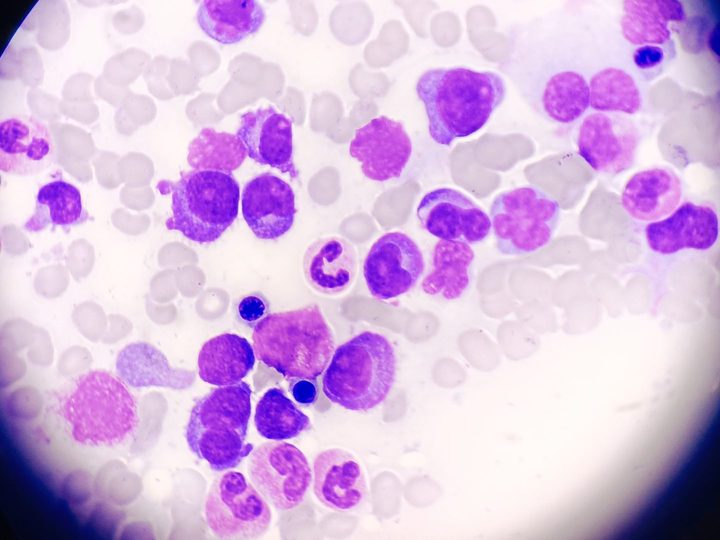 Bone marrow smear: plasmablasts with basophilic cytoplasm and granulocytes