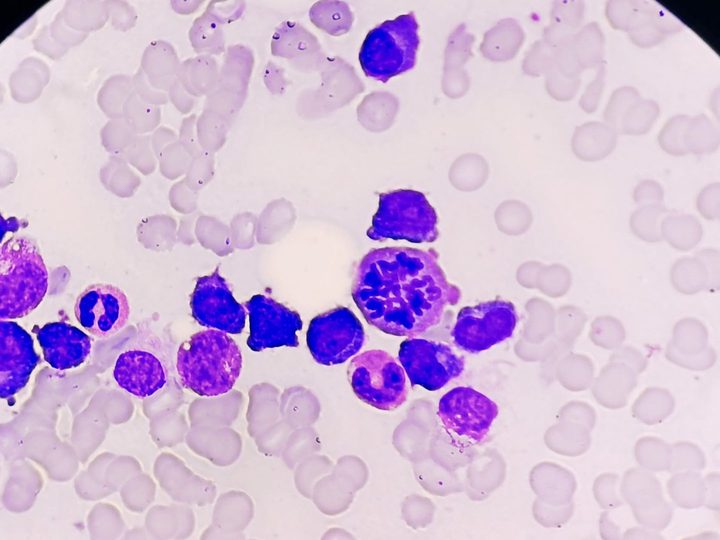 Bone marrow smear: mitotic figure and cluster of atypical plasma cells