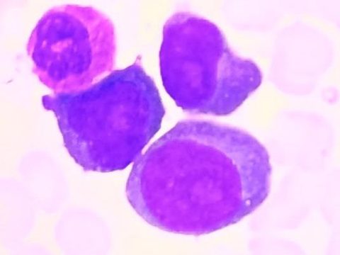Bone marrow smear: large plasmablasts with nucleoli at high magnification