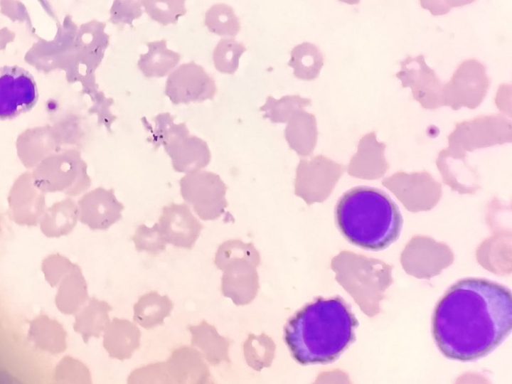 Peripheral blood smear: circulating atypical plasmacytes and plasmablasts