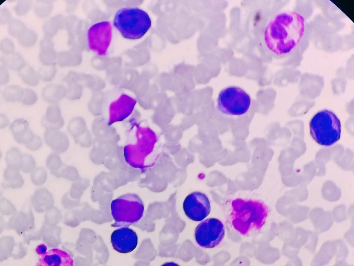 Peripheral blood smear: pronounced leukemization with numerous plasmablasts