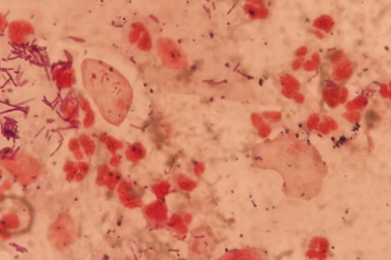 Trichomonads in Gynecological Smear During Pregnancy